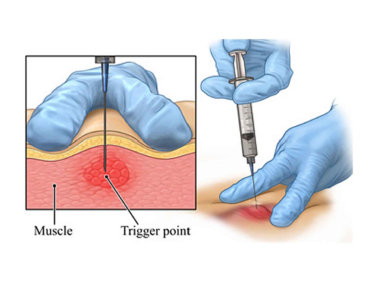 Trigger Point Injections Pain Treatment Center Anesthesiologists