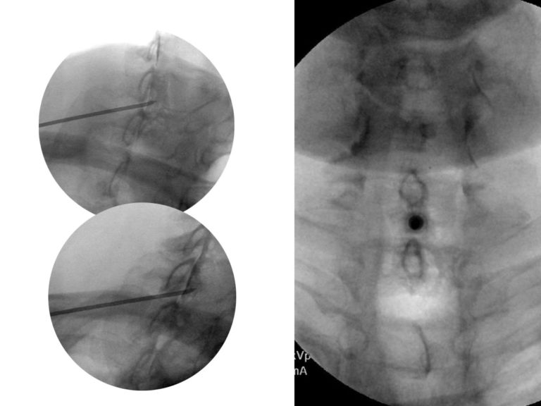 Epidural Steroid Injections Pain Treatment Center Anesthesiologists