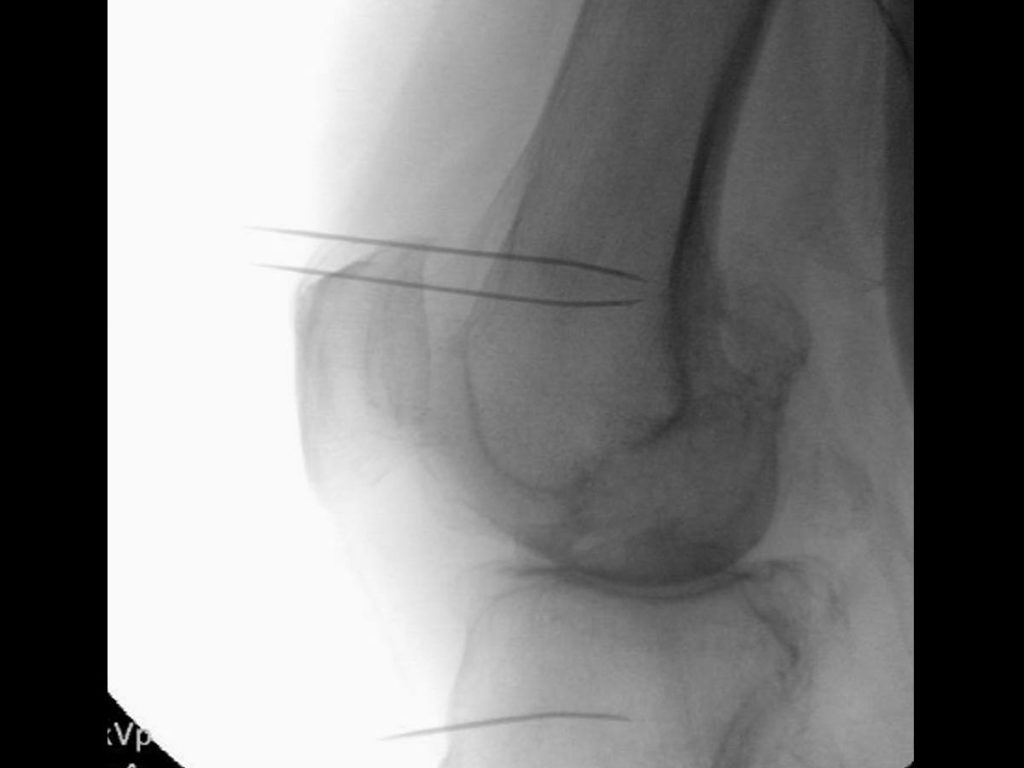 Genicular Nerve