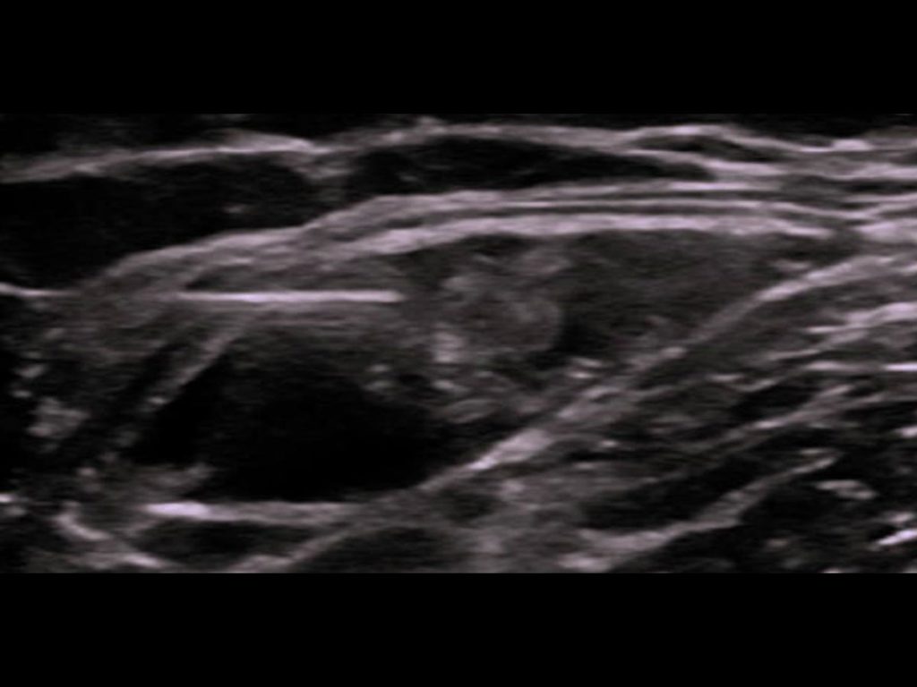 Lateral Femoral Cutaneous Nerve Block​