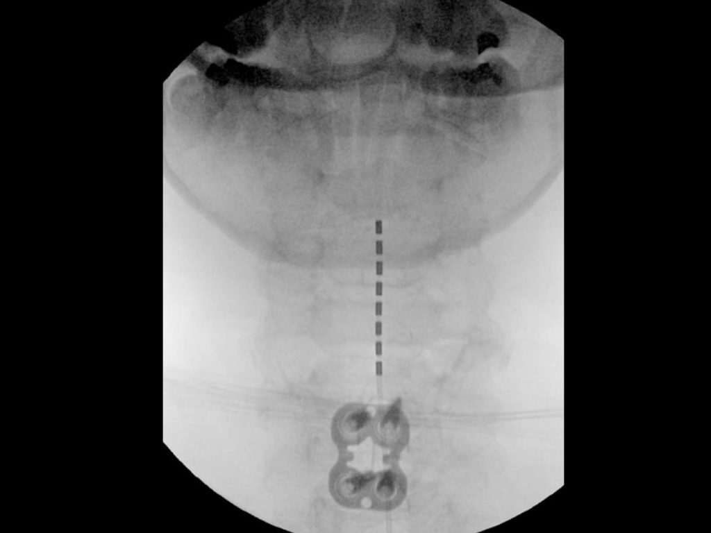 ptca-treatments-Spinal-Cord-Stimulator-3