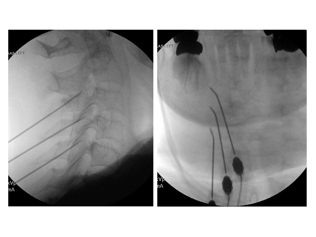 Radiofrequency Ablation – Pain Treatment Center Anesthesiologists