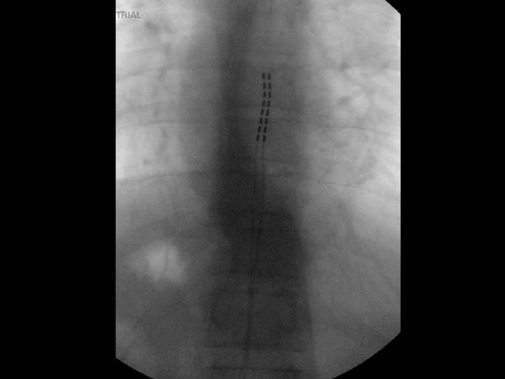 ptca-treatmentsSpinal-Cord-Stimulator-2